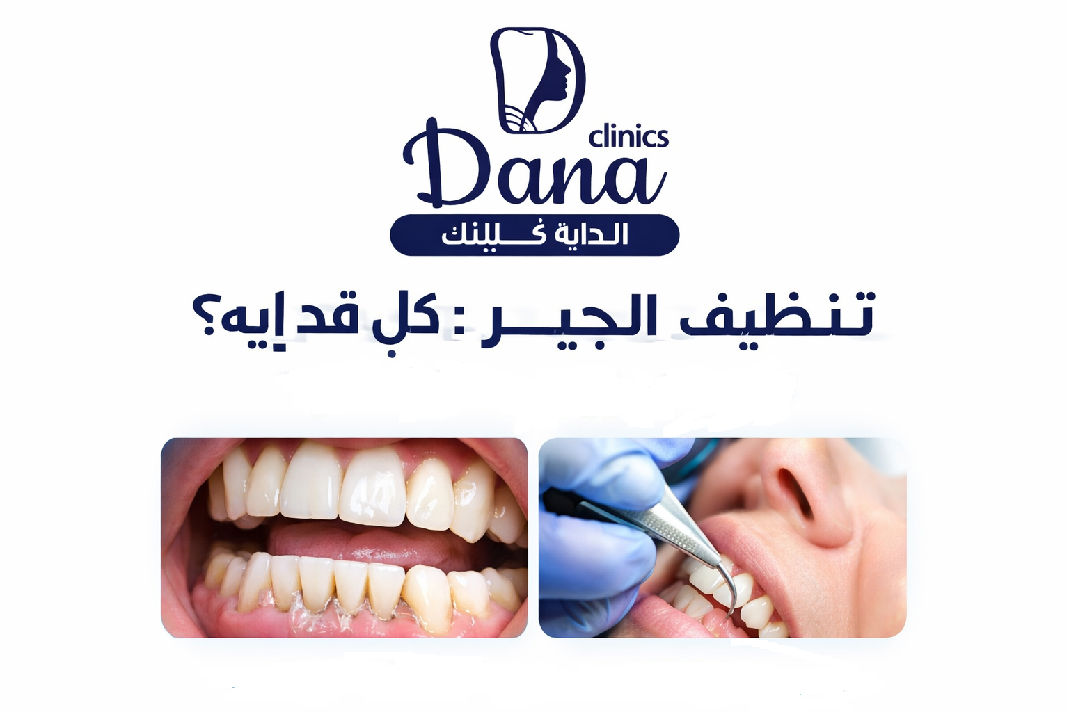 تنظيف الجير: كل قد إيه؟ وإمتى يبقى خطر نتأخر؟ (دليل شامل لصحة اللثة)