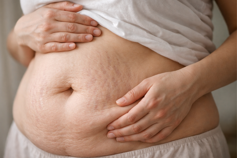 بعد الولادة: تمدد الجلد والترهلات—خيارات واقعية بدون مبالغة